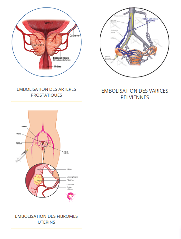 radiologie interventionnelle cancérologie radiologie interventionnelle cancérologie