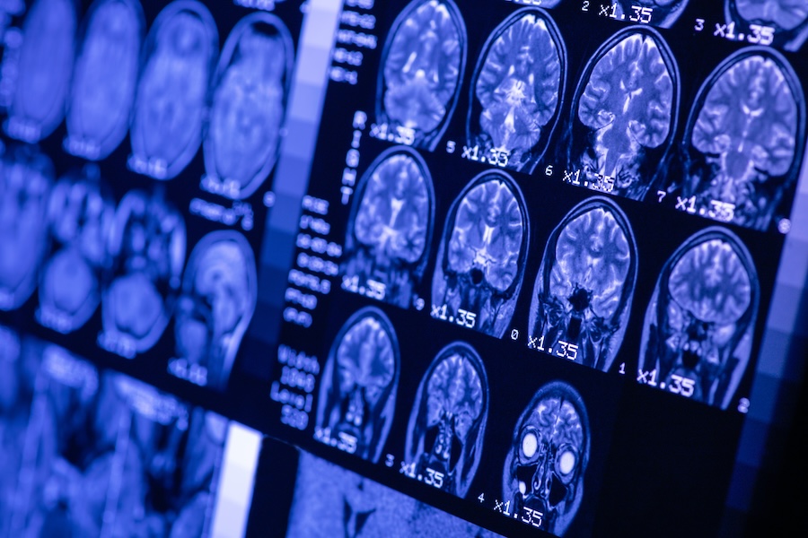 Mri,Of,Brain,Of,A,Healthy,Person,With,Blue,Illumination.